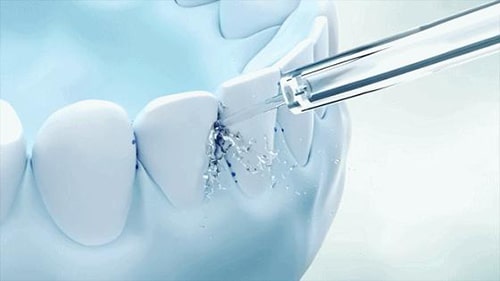 ब्रेसिज़ पहनने वालों के लिए पानी के फ्लोसर्स का लाभ